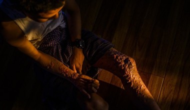 Противопехотные мины: Генсек ООН предупреждает о последствиях ослабления Оттавской конвенции